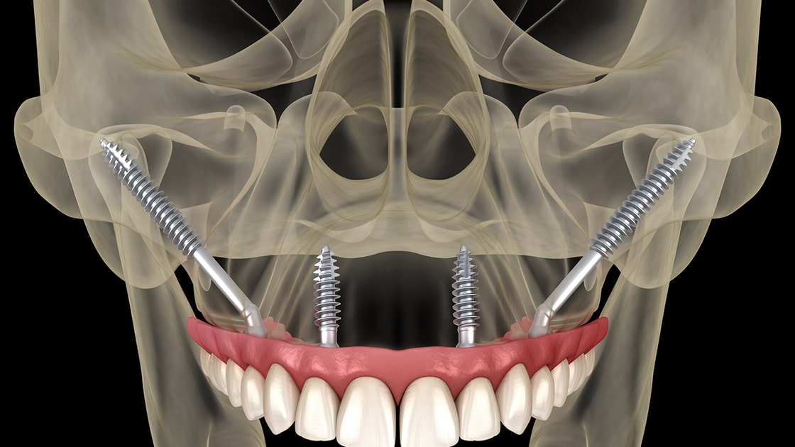 Zygoma Implants